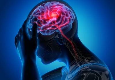Accident vasculaire cérébral – Plus de séquelles chez les patients défavorisés